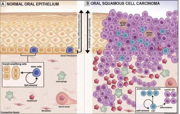Figure 2- Schematic view of normal oral epithelium (A) and oral squamous cell carcinoma (B)