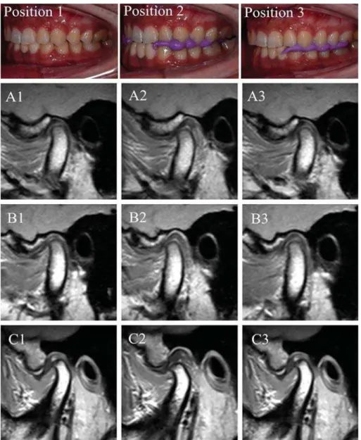 Figure 1- Representative MRIs of three joints in Position 1 (ICP – column 1), Position 2 (ARS – column 2), and Position 3 (SS – column  3)