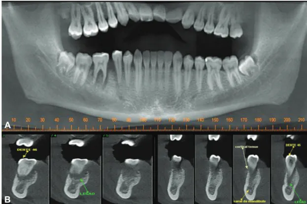 Figure 2-  Cone beam computed tomography (A–B) showing a well-deined osteolytic lesion associated with the roots of teeth #29 and 