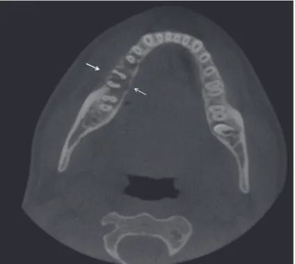 Figure 4- Histopathologic examination demonstrated round to spindle-shaped cells with cellular pleomorphism (A) and osteoid production  (B)