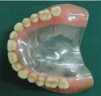 Figure 5-  Amalgam restoration on the lower right irst premolar and dental attrition on the incisal borders of the lower canines as well as  central and lateral incisors (antemortem)