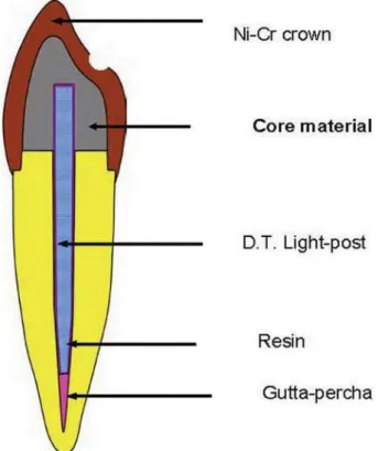 Figure 1- Schematic illustration of tooth specimen with restoration