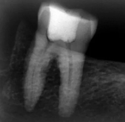 Figura 1 – Imagem radiográfica do primeiro molar inferior com   necessidade de tratamento endodôntico 