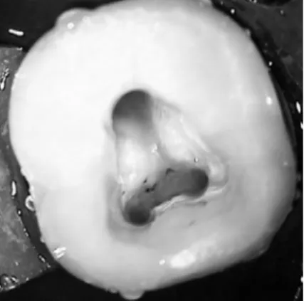 Figura 4 – Aspecto da câmara pulpar após o preparo dos canais mésio-vestibular, mésio- mésio-lingual e distal