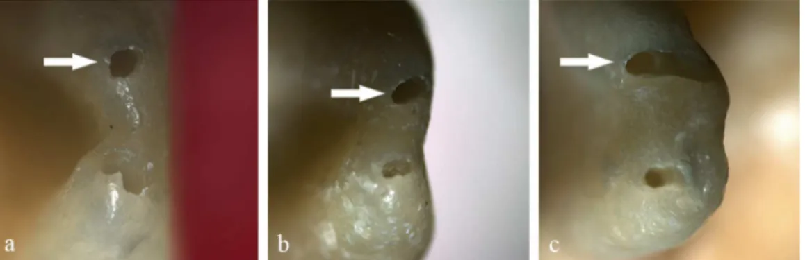 Figure 1-  Apical foramen coniguration examples after mechanical preparation using different techniques and working lengths (a- circular,  b- oval, c- deformed)
