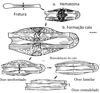Figura 2. Representação gráfica da ossificação intramembranosa.  (Fonte: Human Anatomy e Physiology 7th