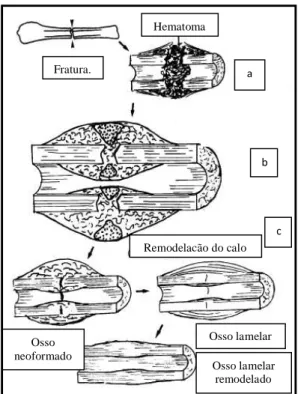 Figura  3.  Ilustração  esquemática  da  consolidação  óssea  secundária. (a) formação do hematoma no local da fratura