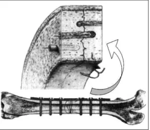 Figura  4.  Esquema  da  ossificação  primária  presente  nas  fixações rígidas aprecia-se no detalhe a correta aposição dos  segmentos ósseos, fator que favorece a consolidação primaria  do osso