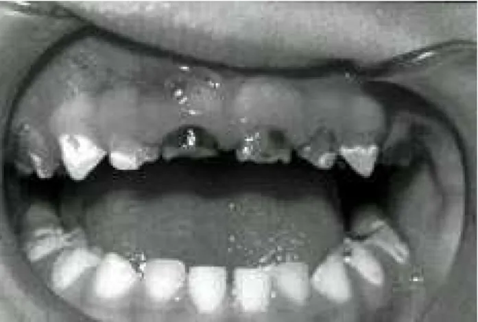 Figure 1 - Typical pattern of carie in infants and preschool children severely affecting upper teeth and lower molars, while lower incisors remain intact
