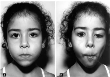 Figure 1 - Five year-old child with Marcus Gunn Phenomenon on the right side, mild upper right eyelid ptosis (A)