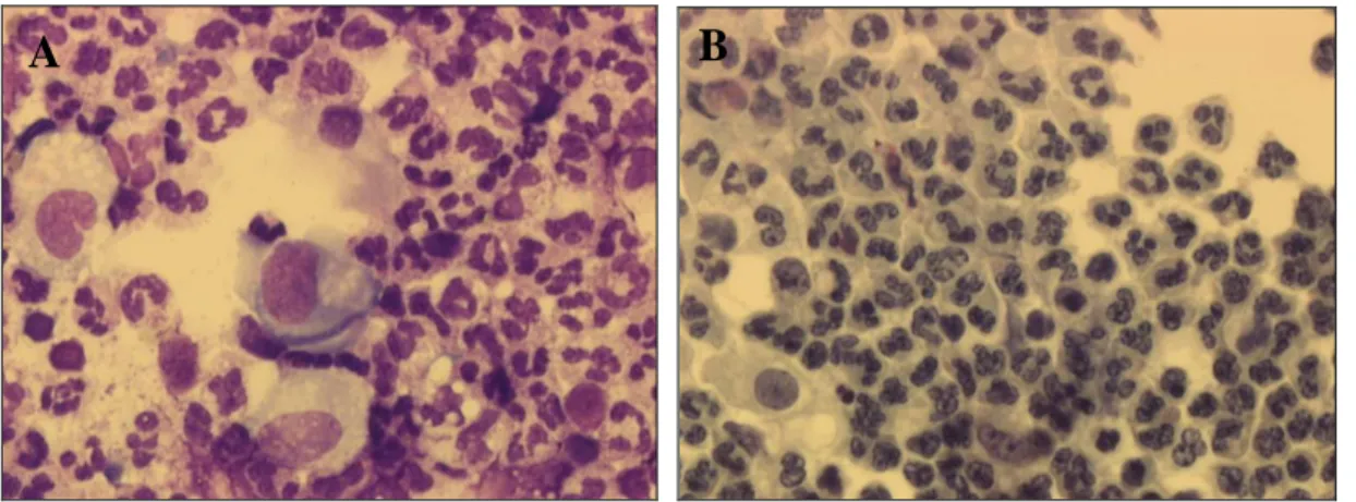 Figura 1: LBA de criança de 8 meses com BOPI, evidenciando alveolite neutrofílica. A)  May-Grunwald-Giemsa, 50x; B) Papanicolau, 50x