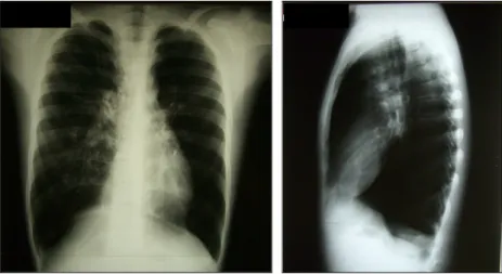 Figura  4:  Radiografia  de  tórax  de  um  paciente  de  16  anos  com  diagnóstico  de  BOPI,  acompanhado no HC-UFMG (Brasil), evidenciando hiperinsuflação bilateral, aumento de  volume pulmonar bilateral e espessamento peribrônquico na região central