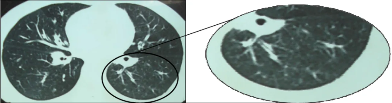 Figura 12: Nódulos centrolobulares em lobo inferior esquerdo, em uma criança de oito  anos, acompanhada no HC-UFMG (Brasil)