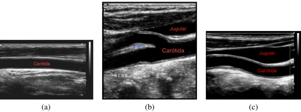 Figura 2.3: Exemplos de imagens de ultra-som modo-B da (a) artéria carótida com placa, (b) da bifurcação da artéria carótida e (c) da artéria carótida com a veia jugular interna