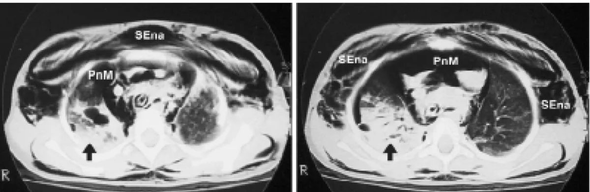 Figure 1 - Endoscopy imaging showing the airway rupture (arrow)