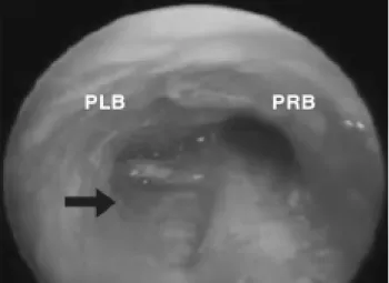 Figure 2 - Endoscopy imaging showing the airway rupture (arrow)PLB = primary left bronchus; PRB = primary right bronchus