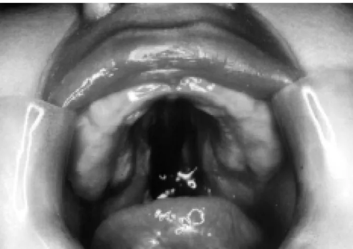 Figure 7  - Severity of glossoptosis determined using nasopharyngoscopy A - Pharynx; B - Bifid uvula;