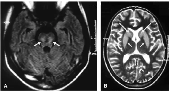 Figure 1  - Brain magnetic resonance imaging.  A) Axial image using the FLAIR sequence within the basis pontis shows lesions caused by myelinolysis (white arrows)