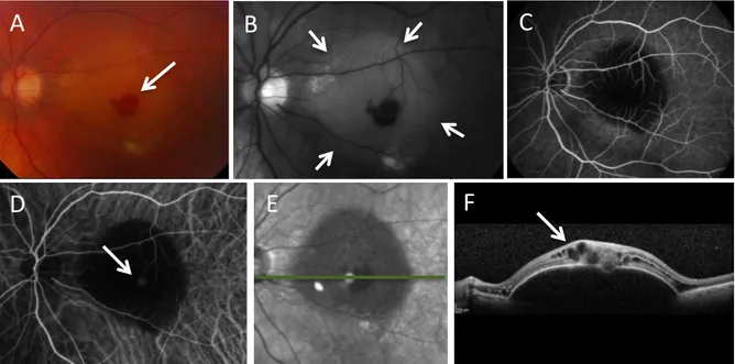 Figura  3  –  Imagens  evidenciam  proliferação  angiomatosa  retiniana  em  olho 