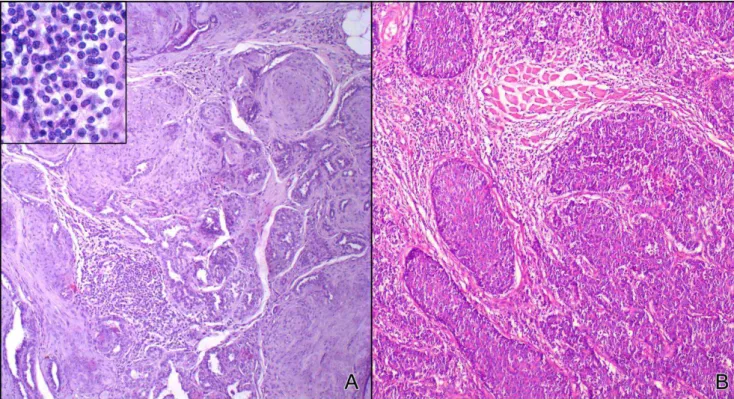 Figure  1  Histological  diagnosis  of  canine  mammary  carcinoma  samples.  Low-power  view  of  tumor  specimen classified as carcinoma in benign mixed tumor (MC-BMT) associated with multifocal lymphocytic  infiltrate, 200× (A); Higher power view of inf