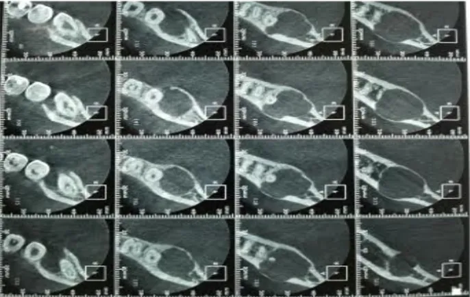 Figura 1. Radiografia panorâmica inicial evidenciando lesão radiolú- radiolú-cida na distal do dente 37.