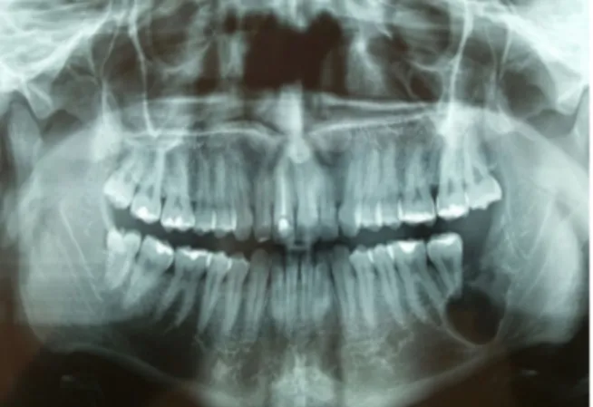 Figura 7. Raios-X Panorâmico de controle é realizado num intervalo de 6 (seis) em seis meses, a partir da remoção do ameloblastoma.