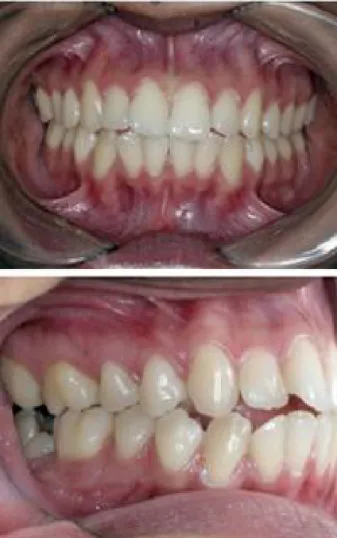 Figura 1. Imagem  intrabucal  inicial.  Clgle  bilateral,  biprotusão,  api- api-nhamento  anterior  e  dente  47  mesializado  e  impactado  na  distal  do dente 46.