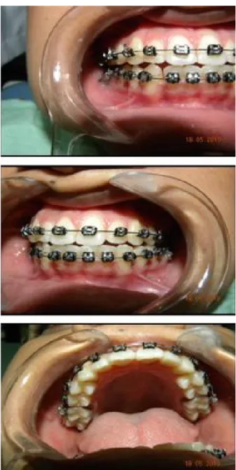Figura 3. Fotografia intrabucal instalado aparelho ortodôntico fixo.