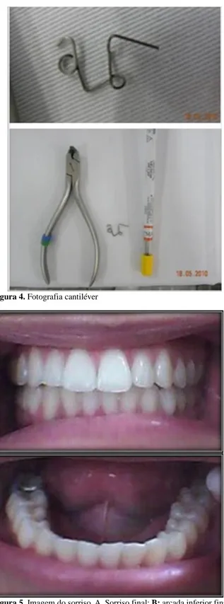 Figura 5. Imagem do sorriso. A. Sorriso final; B: arcada inferior final.
