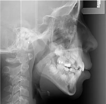 Figura  6. Radiografia  panorâmica  evidenciando  o  irrompimento  dos dentes  dentro  da  faixa  etária  esperada  e  sem  nenhuma  interferência;