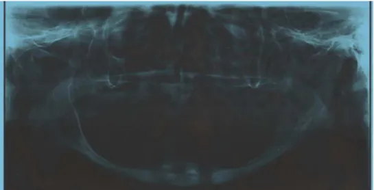 Figura 7: Radiografia panorâmica atual da paciente (31-07-2013) em acompanhamento clínico  pela CTBMF