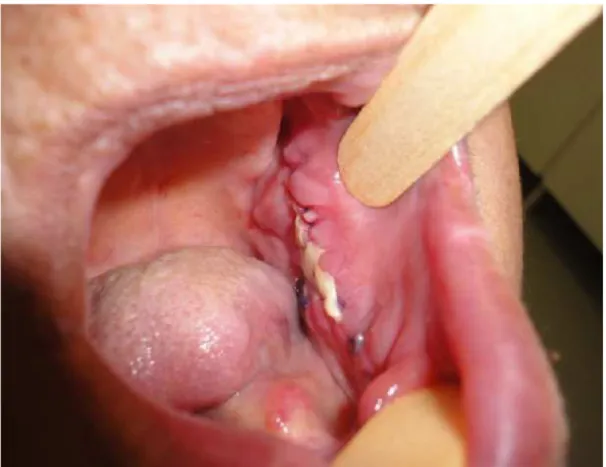 Figura 9: Vista intra Oral. Pós operatório de 07 dias. Cicatrização satisfatória. 