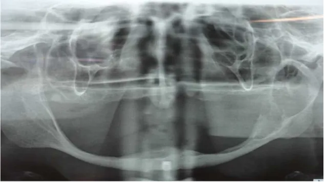 Figura 11: Radiografia atual ( Julho/2013), acompanhamento de Carcinoma Mucoepidermóide  Intra Osseo em Mandibula 