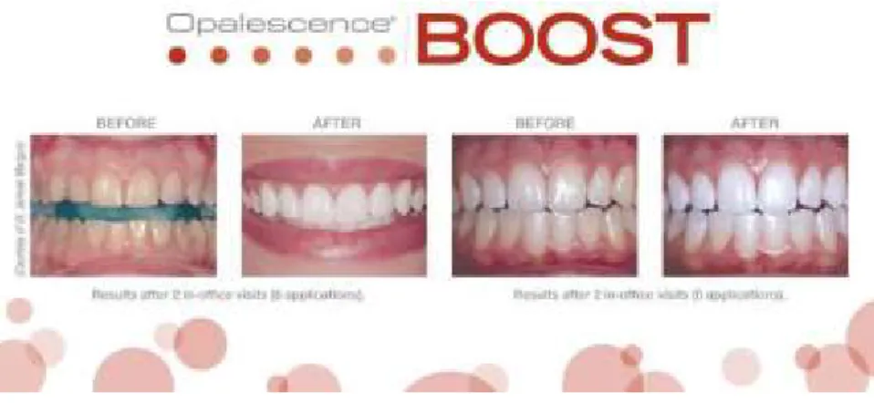 Figura 2: Imagens pré e pós branqueamento no consultório (in-office) com a supervisão do médico  dentista https://willisdentistry.com/cosmetic-treatments/teeth-whitening/opalescence-boost/ 