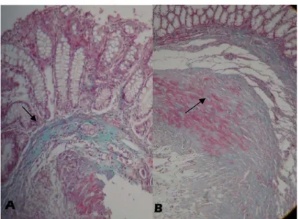 Fig. 7 Fotomicrografia da concentração de fibras colágenas  (seta)  na  submucosa  do  cólon  obstruído  de  ratos  tratados  ou  não  com  o  sildenafil,  classificado  como  leve  (A)  ou  acentuada (B), em aumento de 200 x 