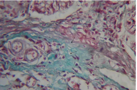 Fig. 8 Fotomicrografia da aspecto histológico de fibras colágenas  finas,  tortuosas,  características  de  fibras  colágenas  imaturas,  (seta) na submucosa do cólon obstruído de ratos tratados ou não  com o sildenafil (aumento de 400 x) 