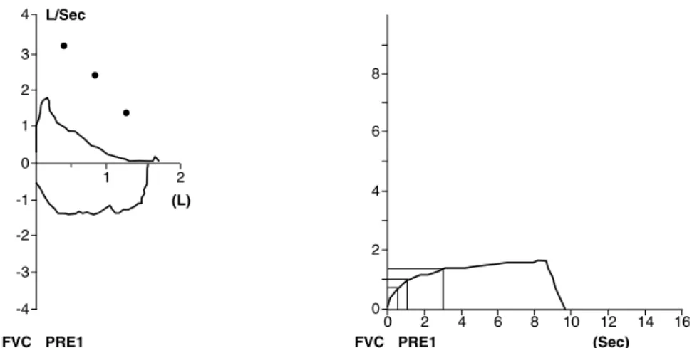 Figure 3 -  Spirometry  indings  of  a  10-year-old  patient  with  post-infectious  bronchiolitis  obliterans  seen  in  Hospital  de  Clínicas  of  UFMG  with  moderate  obstructive  ventilation disorder: Forced vital capacity (FVC) = 95%, Forced expirat
