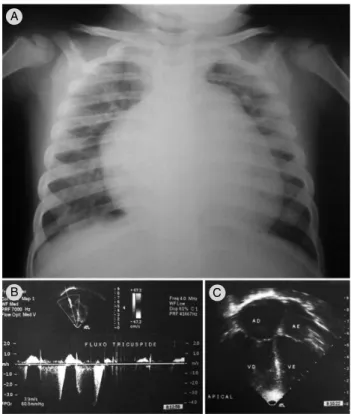 Figure 5 -  Child  with  history  of  acute  viral  bronchiolitis  at  1  month, followed by recurrent pneumonia that required  hospitalization in intensive care unit