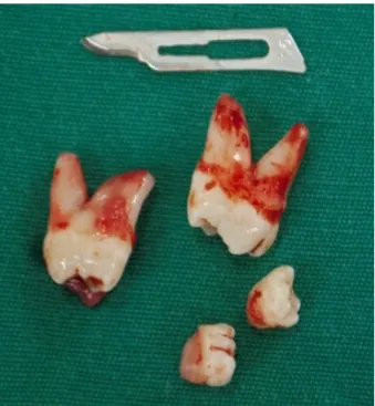 Figura 6. Dentes 18 e 28 e distomolares superiores.