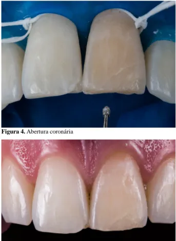 Figura 3. Altura coronária.