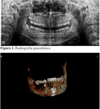 Figura  2. Tomografia  computadorizada  evidenciando  o  posiciona- posiciona-mento dos dentes retidos.