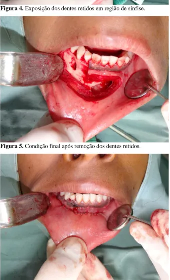 Figura 5. Condição final após remoção dos dentes retidos.