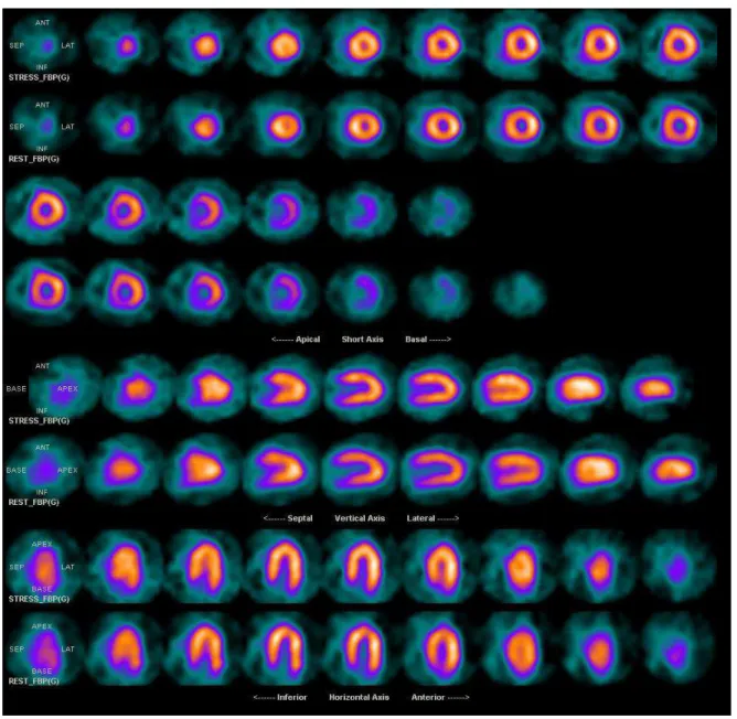 Figura 3 -  Imagem da perfusão miocárdica de um paciente controle normal  demonstrando uma distribuição homogênea do radiofármaco nas  paredes do ventrículo esquerdo em esforço (fileira superior) e no  repouso (fileira inferior) nos eixos curto, horizontal