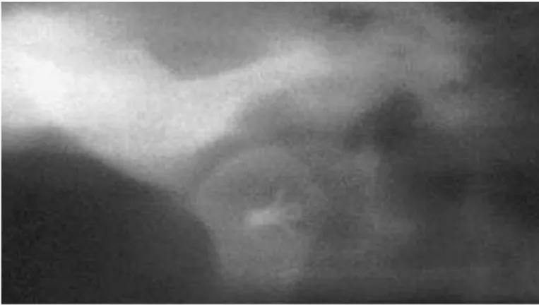 Fig. 47. Aspecto radiográfico das mini-âncoras.  Fonte: FIELDS e WOLFORD, 2001. 