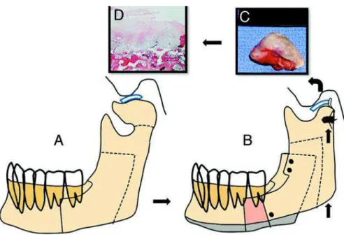 Fig. 22. Esquema cirúrgico e peça anatômica do caso de osteocondroma.  Fonte: WOLFORD, CASSANO e GONÇALVES, 2009