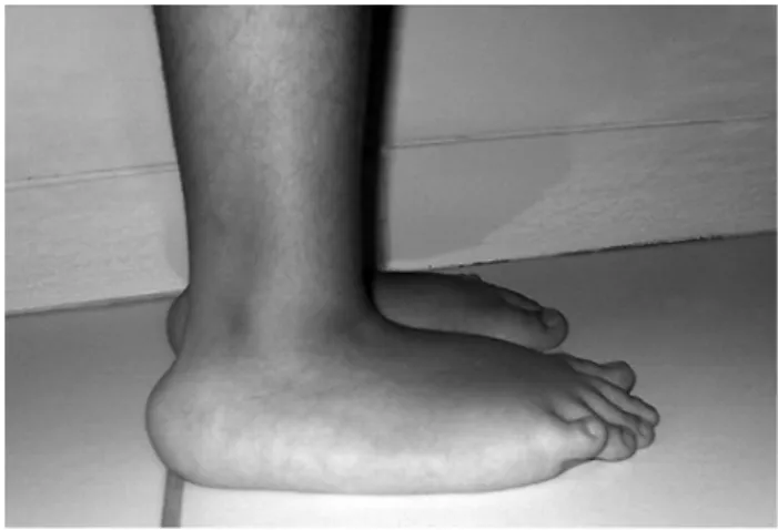 Figure 1 -  Foot  of  the  patient  showing  the  characteristic  protuberant calcaneus