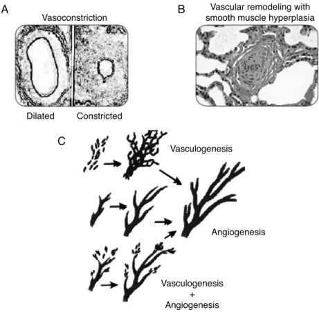 Figure 5 Pathogenesis of PPHN syndrome: vasoconstriction (A), vascular remodeling (B), angiogenesis, and vasculogenesis (C).