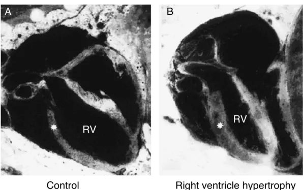 Figure 6 Right ventricle (RV) wall hypertrophy in rat fetuses exposed to indomethacin, compared with normal rats