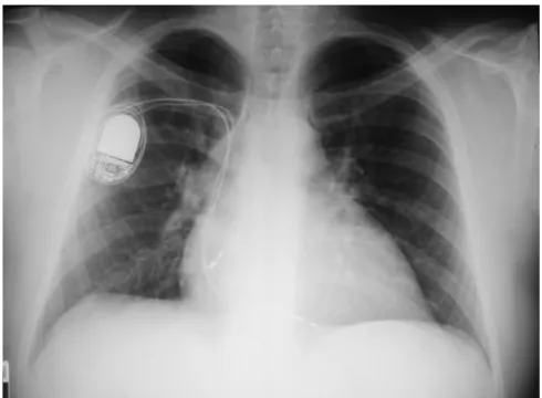 FIGURA 4 - Telerradiografia do tórax mostrando aumento da área cardíaca em paciente 