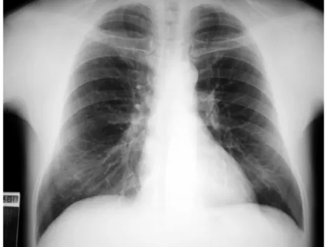 FIGURA 5 - Telerradiografia do tórax apresentando fluxo venoso pulmonar normal. 